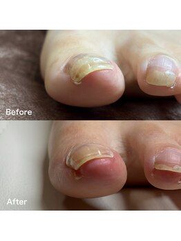 巻き爪矯正2回目(左親指)