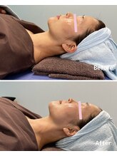 おおむら鍼灸接骨院/フェイシャル Before＆After