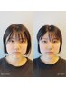 【撮影モニター募集】超☆小顔美容鍼コース60分/¥22000→5000