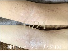 ヴィーダ 渋谷松濤(ViDA)/腕の肌質改善