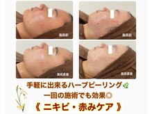 フェイシャルエステ エムズルーム(M's room)/1回の施術でも赤み・ニキビ予防