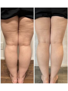 ミミルーチェ(mimiluce)/太腿やふくらはぎの足ほっそり！