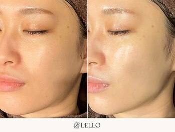 レロ 恵比寿店(LELLO)/美白ケアに特化した施術です