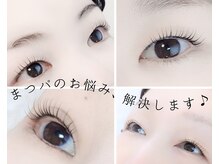一重、たるみなどお悩みはご相談ください！ぱっちりあげます♪