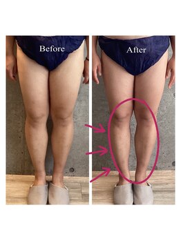 サクランボ(SAKURAMBO)/ 痩身インディバxNONFエナジー2