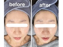 ハロ 南青山(HALO)/小顔3層打ちフェイシャル