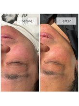 ヴィーナス(Venus)/ヒト幹細胞ピーリング　3回