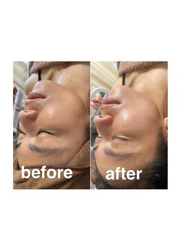 マホロバ(mahoroba)/美容鍼×ハーブピーリング