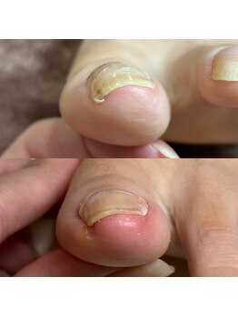 巻き爪矯正2回目(左親指)