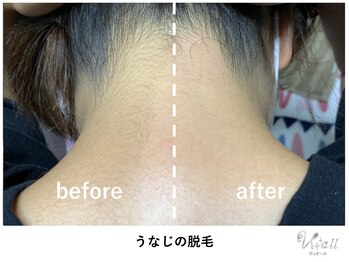 ヴィ オール(Vi.all)/うなじのワックス脱毛