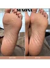 マオヌー(MAONU)/韓国式足裏角質ケア　症例写真
