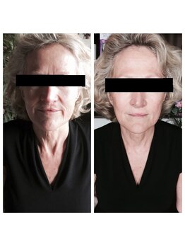 ぐりーんりぷる/金箔エステ1回の変化！