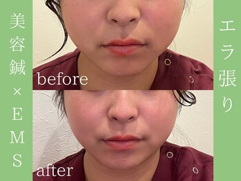 ビープラス(BEE PLUS)/食いしばりによるエラ張り