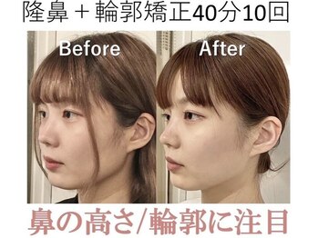 ラプリ 梅田店(Raplit)/隆鼻＋輪郭矯正40分10回