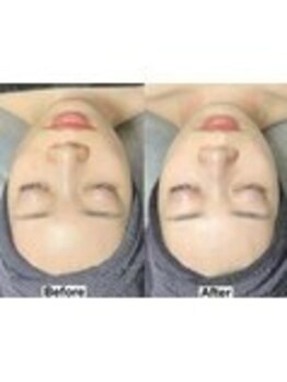 アンドミー 鹿児島中山(&me)/ララピール【艶肌/美白/くすみ】