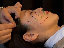 アロエベル(aloe Belle)/美容鍼