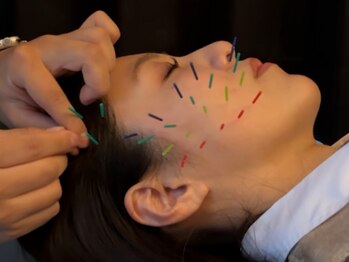 アロエベル(aloe Belle)/美容鍼