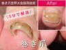 【巻き爪世界大会採用技術◎強く巻いた爪に ワイヤー矯正 親指1本】￥12,000