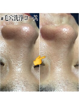 エステルーム クリスタル/ごっそり毛穴洗浄