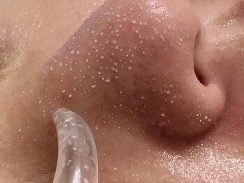 シャイン(Shine)の写真/メンズだって気になる毛穴【韓国式3D毛穴洗浄】で顔中の毛穴を洗浄！ツルツル肌を是非体感してください！