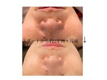 毛穴の汚れ取り＆ギューッと引き締めフラットな肌を目指します。