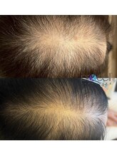 リベルテ(Liberte)/プロセルセラピーズ／頭皮