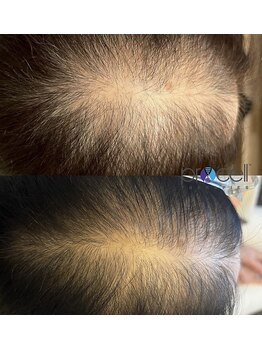 リベルテ(Liberte)/プロセルセラピーズ／頭皮