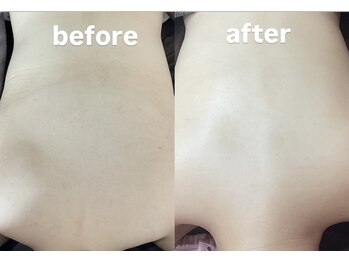 ナルシス(Narcissus)/背中ハーブピーリング