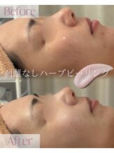 モア 星ヶ丘店(MORE)/ハーブピーリング