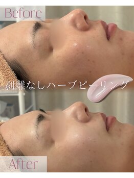 モア 星ヶ丘店(MORE)/ハーブピーリング