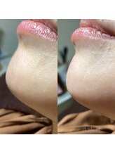 ジル(JILL)/トリプルWAXスキンケアWAX脱毛