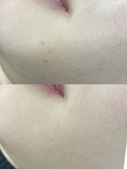 ミウ(MIU)/プラズマ+シミケア