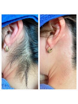 サロンアンドスクール ローズマリー (Salon&School Rosemary)/うなじと首のワックス光併用も可