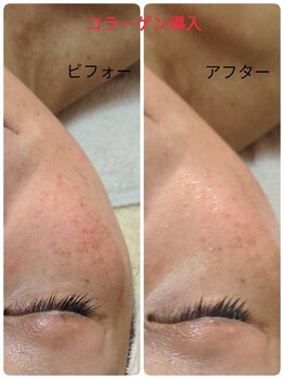 ラヴィアンローズ 蒲郡店(& La vie en Rose)/コラーゲン導入