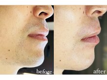 ビビ イーストフィールド 天白 名古屋(vivi)/ひげ脱毛5回経過でこの違い♪