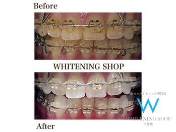 ホワイトニングショップ 甲賀店/Before&After『ホワイトニング』