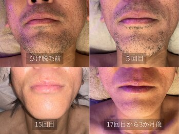 アルム(Arum)/ひげ脱毛