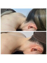 ミース 名古屋駅前店/ ★うなじ脱毛BeforeAfter