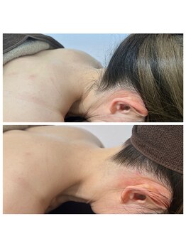 ミース 名古屋駅前店/ ★うなじ脱毛BeforeAfter