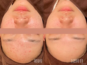 ウォーム(warm)/ニキビケア/肌荒れ/ニキビ肌