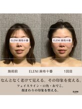 エレーニ 麻布十番(ELENI)/気になっていた顔まわりに変化。