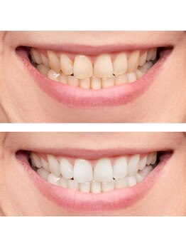 宮崎セルフホワイトニング/アフターケアもおすすめ☆