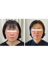 ワイサロン(Y salon)/【小顔症例】コルギ11回目