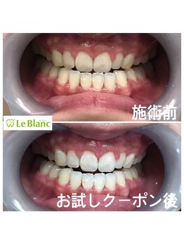 ルブラン 奈良店(Le Blanc)/削らず白く(^ ^)