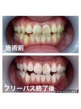ホワイトニングサロン 京都烏丸店/ホワイトニング施術例
