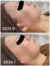 美フレイン/短期集中で一気に