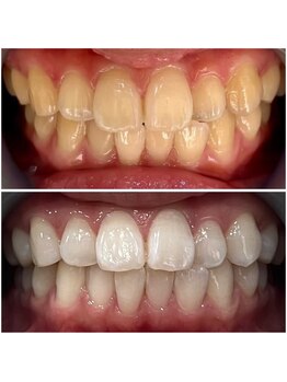 ホワイトニングショップ 新居浜店/結果重視サロン