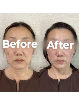 レオ(LEO)/Before→After