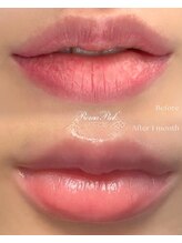 ティースリー(T3)/最先端黒ずみケア！ローマピンク