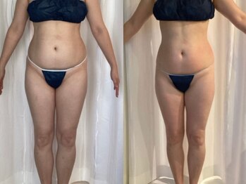 ジョーヌ(JAUNE)/1回でもスッキリ薄いボディへ